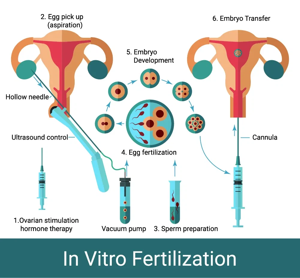 IVF 절차에서 계란 검색 바늘의 다양한 크기의 효과